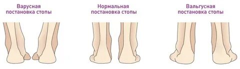 Эквино вальгусные стопы
