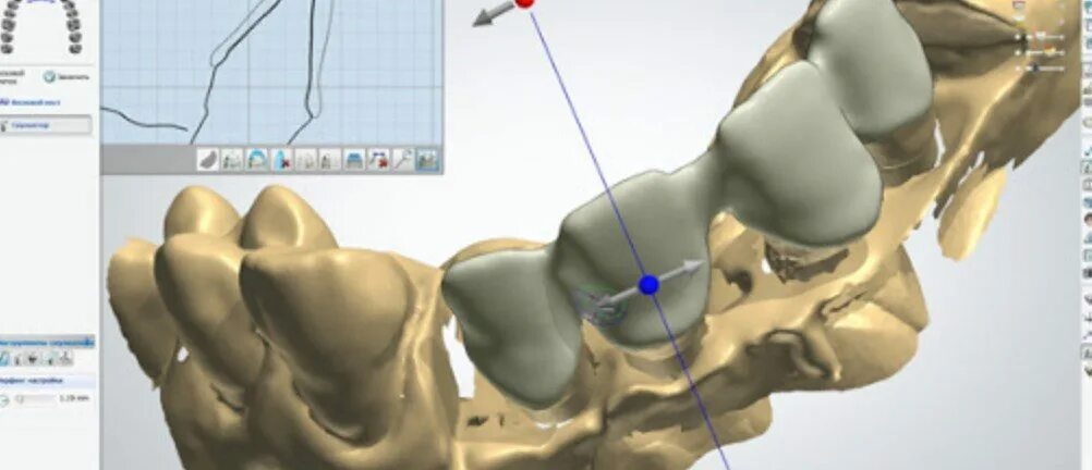 Cad cam моделирование. Cad cam технологии в ортопедической стоматологии. эксокад. exocad программа.