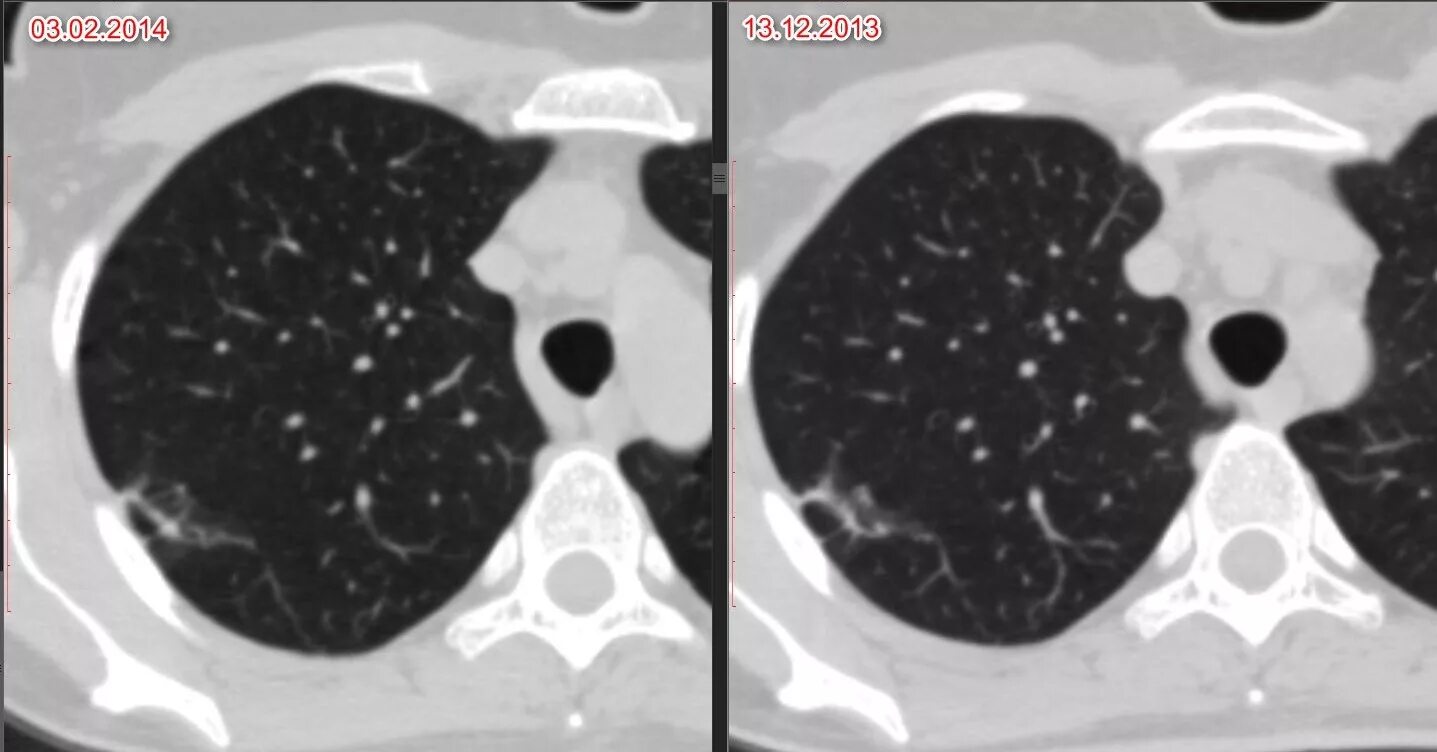 Показывает ли кт бронхит. Бронхоэктатическая болезнь легких на кт. Хронический обструктивный бронхит кт. Острый обструктивный бронхит рентген. Хронический обструктивный бронхит кт.
