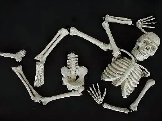 Сломанная кость человека скелет.