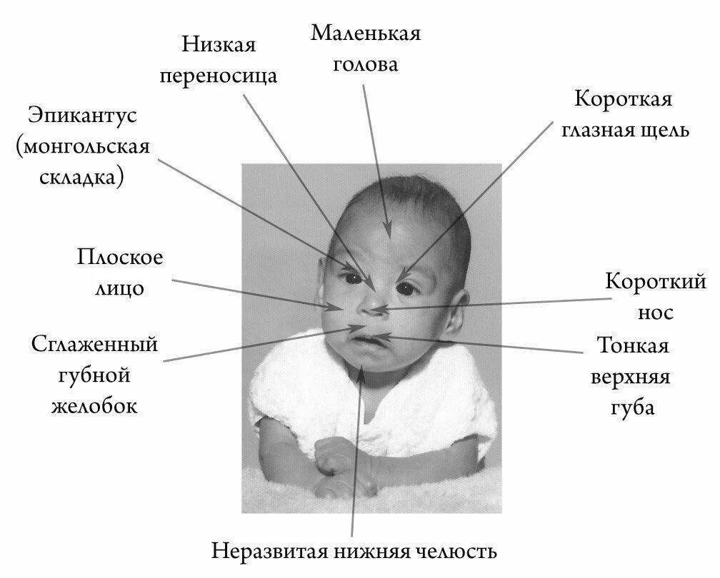 Признаки фетального алкогольного