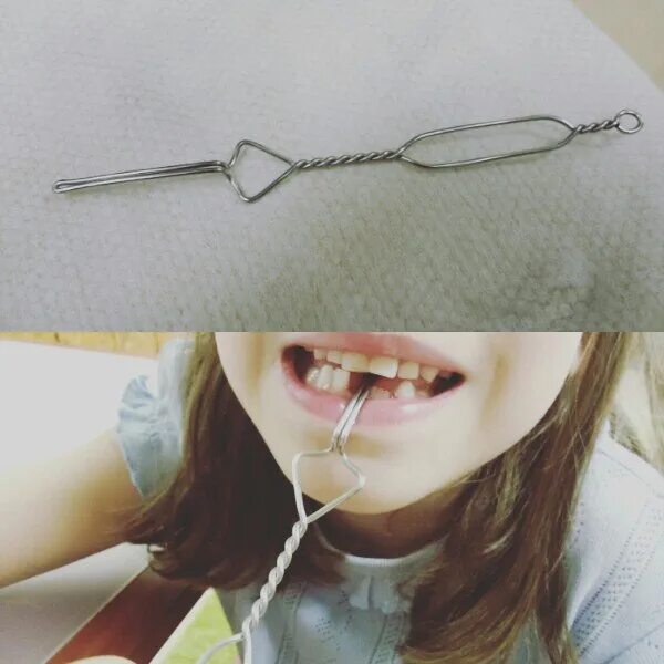 Шариковый зонд для постановки звука р. Постановка звука с механическим способом. Постановка р зондом. Постановка р зондом. Зонд постановочный для звука р.