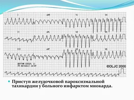 Тахикардия форум