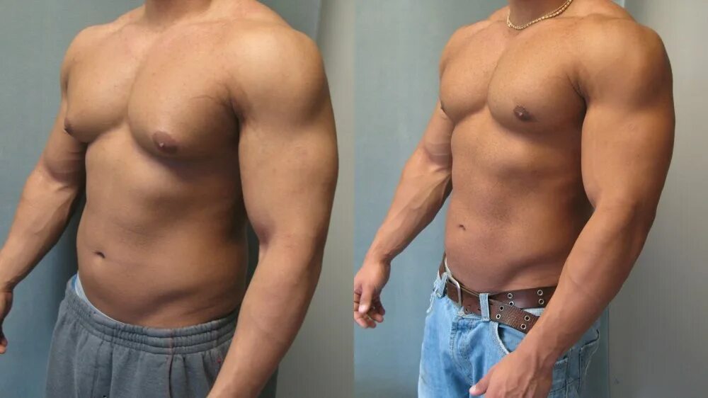 Удаление жира у мужчин. Что такое Гино в бодибилдинге. Гинекомастия грудных мышц.