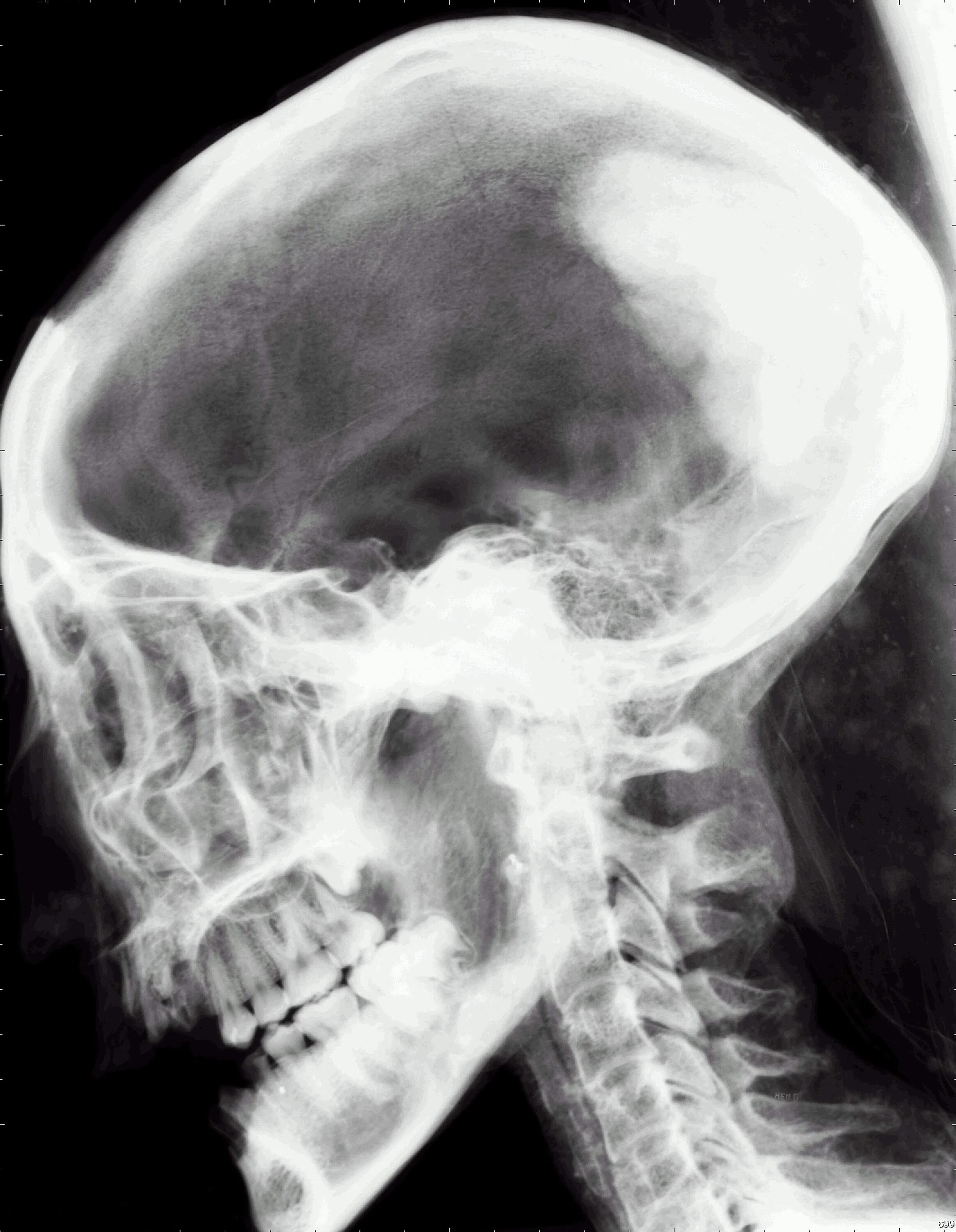 Трещина в голове. Рентгеновский снимок черепа. Обзорный снимок черепа.