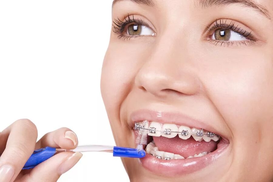 сапфировые брекеты inspire ice. темы ортодонтия. Mini diamond ormco. самолигирующиеся брекеты damon. брекеты металлические безлигатурные slx dynaflex.