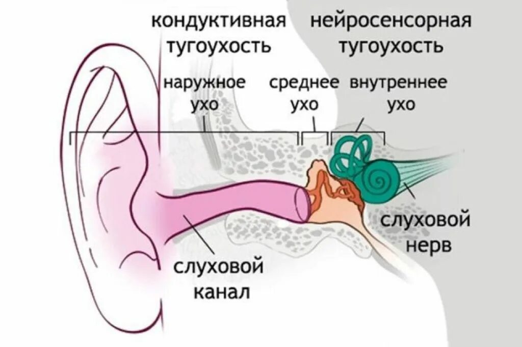Тугоухость что это такое. Тугоухость и нейросенсорная глухота. механизм развития нейросенсорной тугоухости:. левосторонняя сенсорная тугоухость. нейросенсорная тугоухость и глухота связана с патологией.