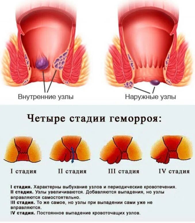 Можно ли избавиться от узлов