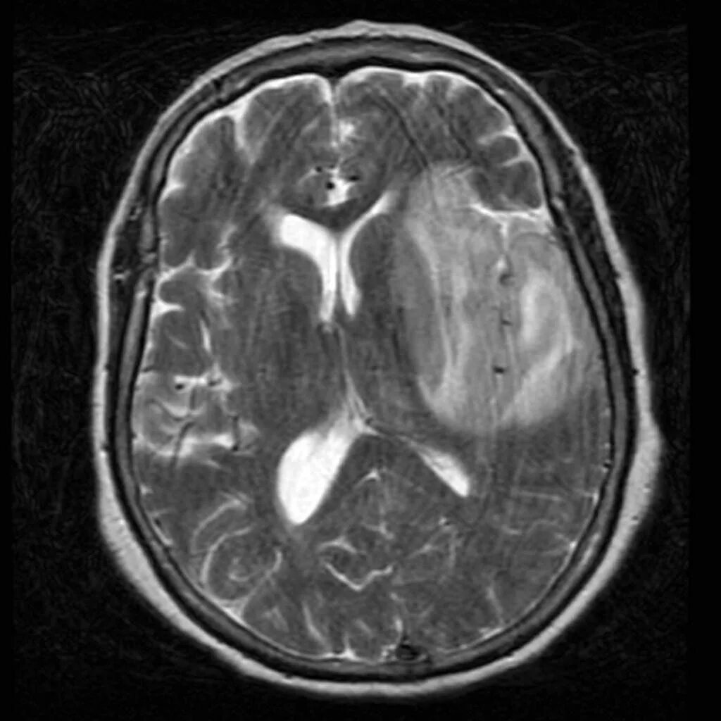 Герпетический энцефалит кт. Менингоэнцефалит на кт головного мозга. Энцефалит головного мозга мрт. Энцефалит головного мозга у взрослых