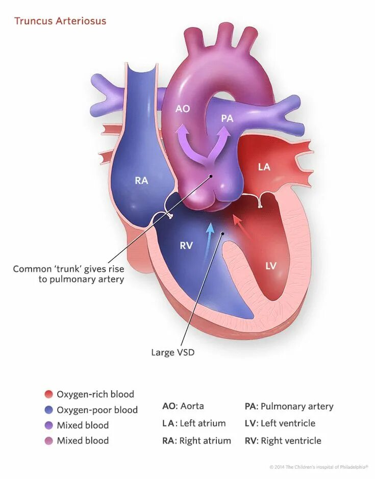 Plexus arteriosus. Truncus arteriosus анатомия. persistent truncus arteriosus. truncus arteriosus латынь. аорто левожелудочковый тоннель.