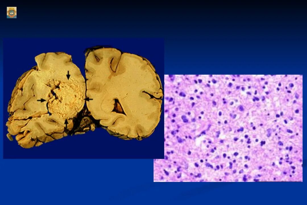Анапластическая астроцитома гистология. Пилоцитарная астроцитома гистология. Астроцитома головного мозга патанатомия. Глиома головного мозга гистология. Диффузная астроцитома