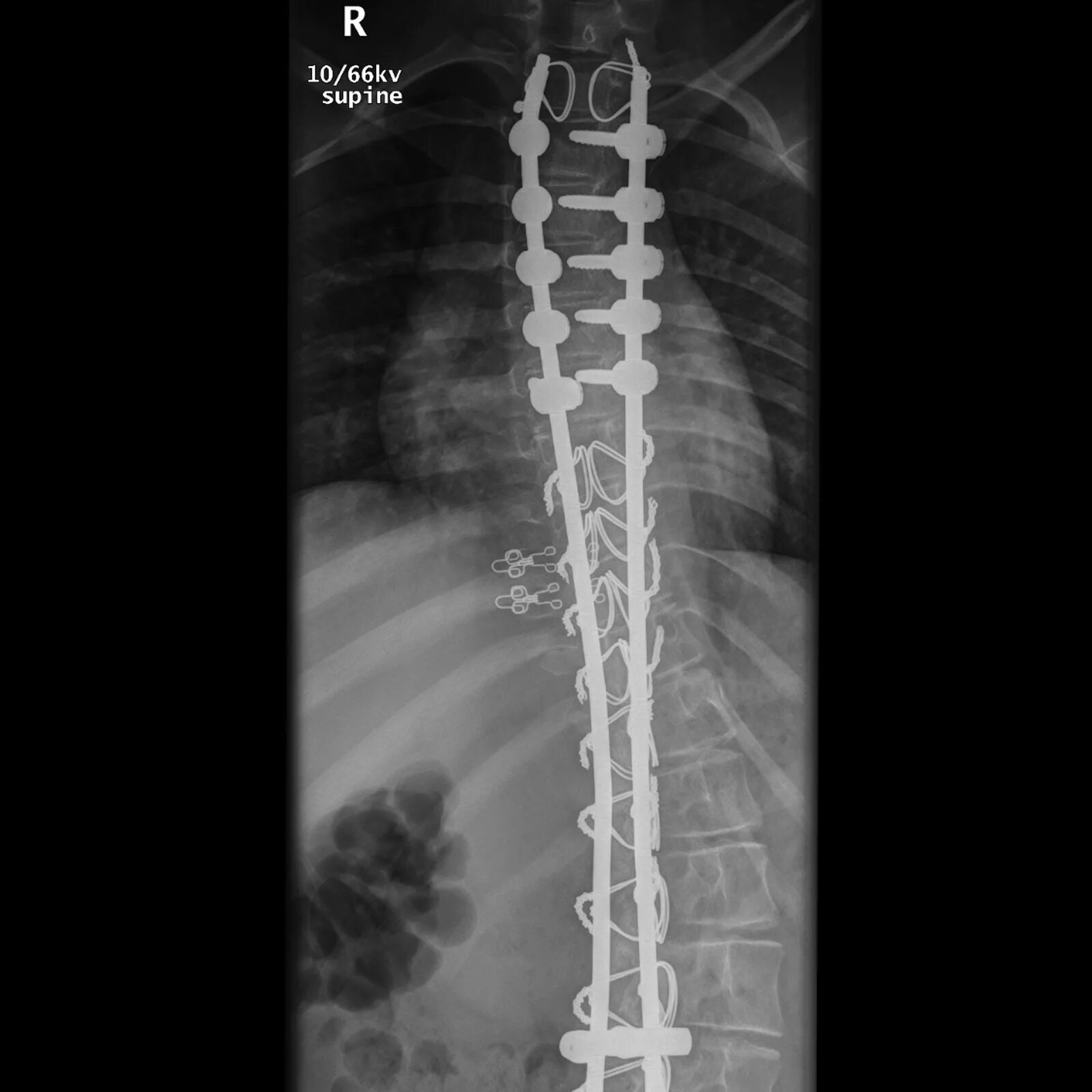 Тест с ответами проксимальная спинальная мышечная атрофия. Spinal muscular atrophy. спинальная мышечная атрофия 2 типа. спинально мышечная атрофия рентген. спинал мушак атрофияси.
