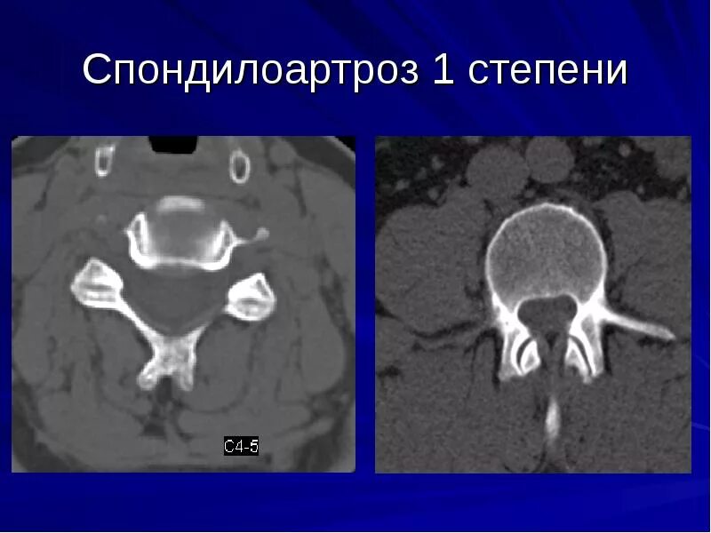 Спондилоартроз 3 стадии. Спондилоартроз 1 степени поясничного отдела позвоночника. спондилоартроз 2 степень на мрт. спондилоартроз 2 степени поясничного отдела. спондилоартроз шейного отдела позвоночника кт.