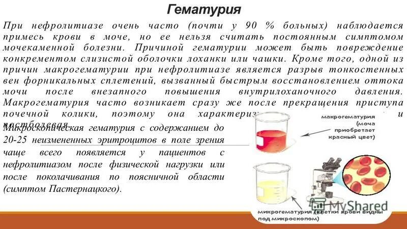 Моча кровь что пить. Мочекаменная болезнь гематурия. Моча с примесью крови. Моча с кровью у женщин причины.