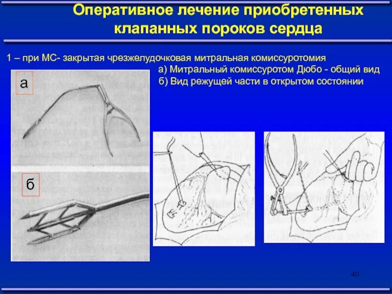 Что значит оперативное лечение. Митральная комиссуротомия операция. Аортальная комиссуротомия. Операции при приобретенных пороках сердца Оперативная хирургия. Принципы хирургического лечения приобретенных пороков сердца.