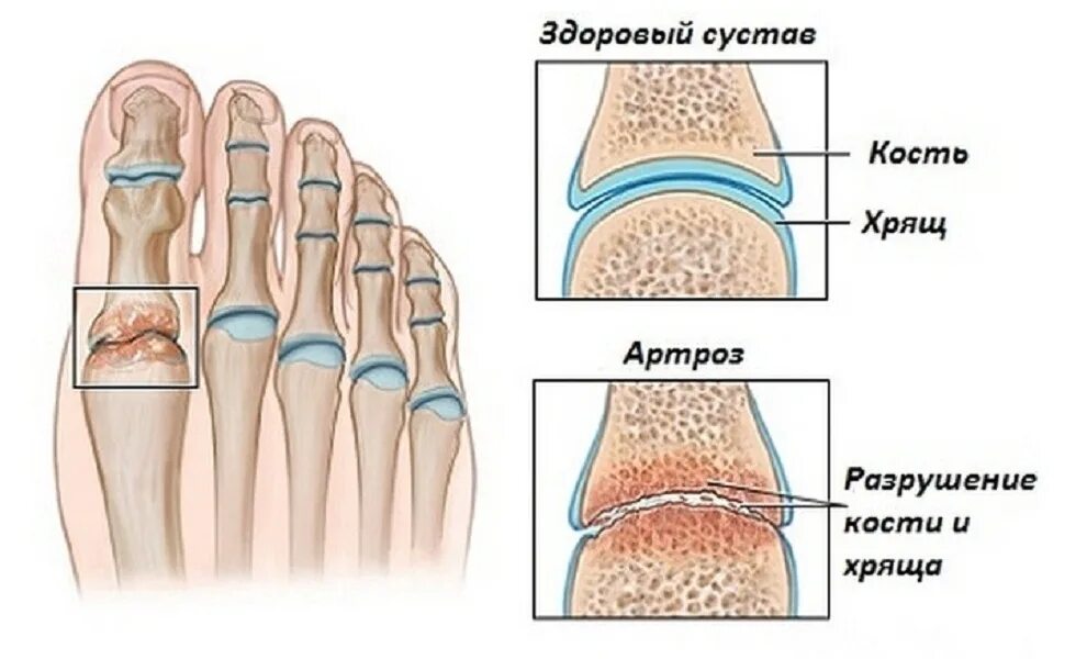 Плюснефаланговый артрит