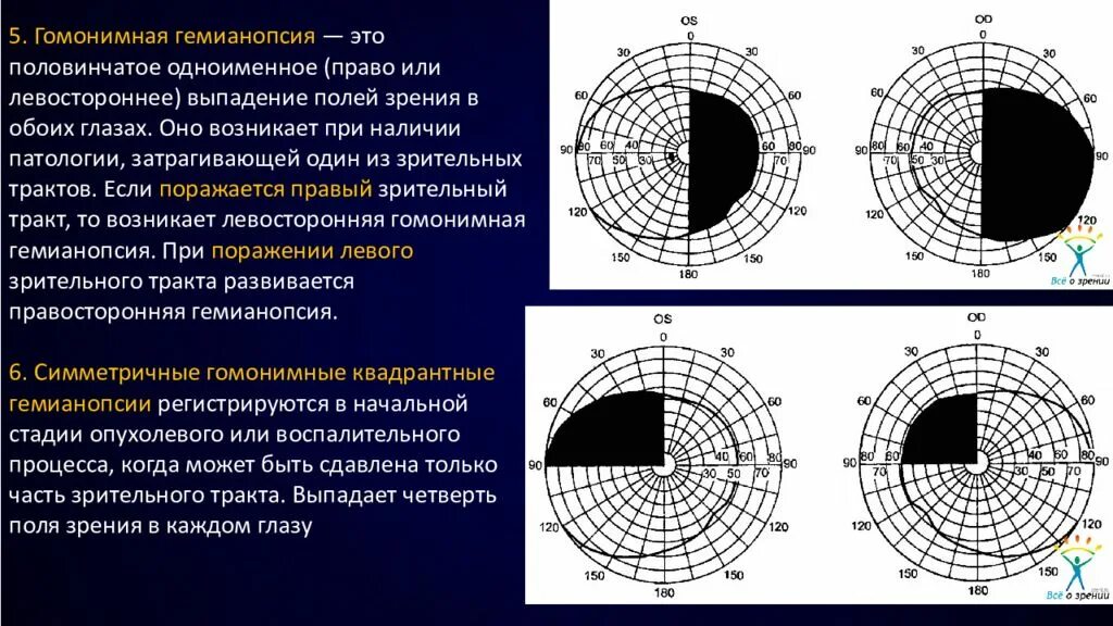 Гетеронимная битемпоральная гемианопсия причины. Правосторонняя гемианопсия очаг поражения. Выпадение полей зрения периметрия. Верхняя квадрантная гомонимная гемианопсия.