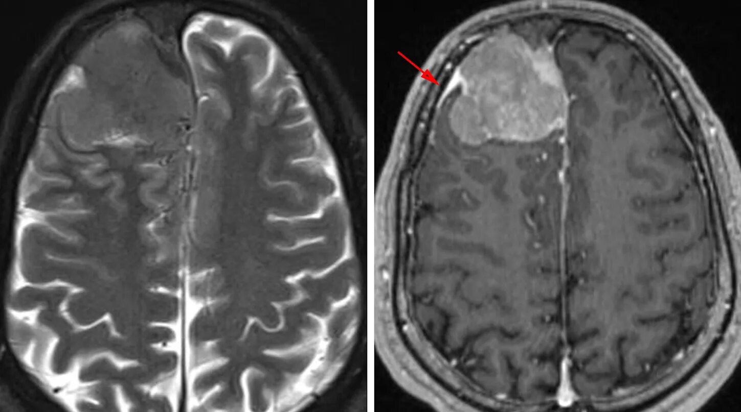 Менингиома лобной доли кт. Менингиомы головного мозга на кт. Конвекситальная менингиома мрт. Менингиома лобной кости кт. После операции менингиомы головного мозга