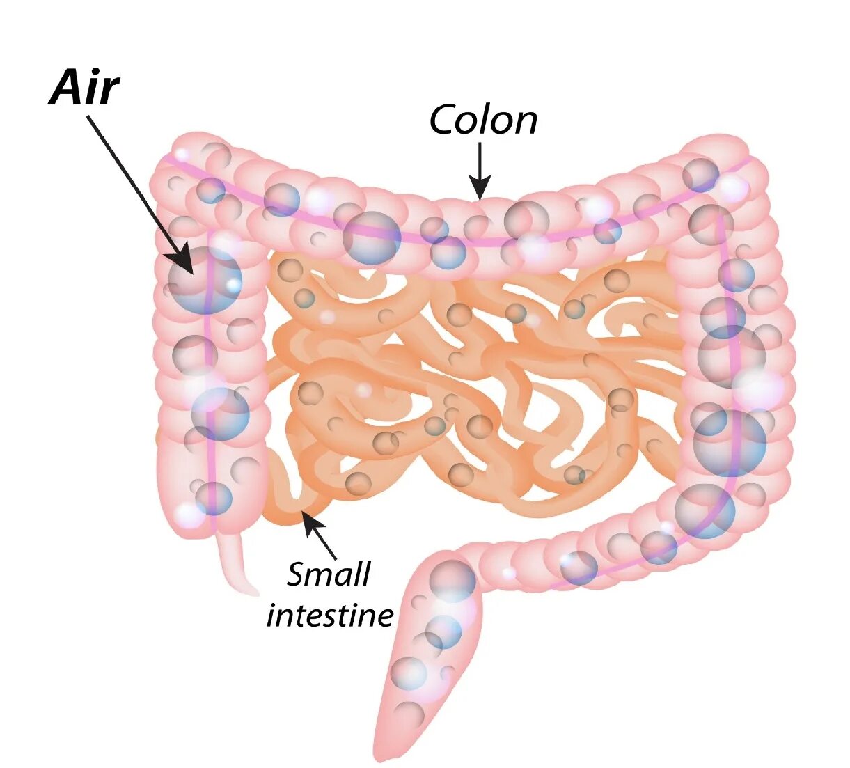 Воздух животе причина. Скопление газа в кишечнике. Пузырьки газа в кишечнике. Газовые пузырьки в кишечнике. Образование газов в кишечнике.
