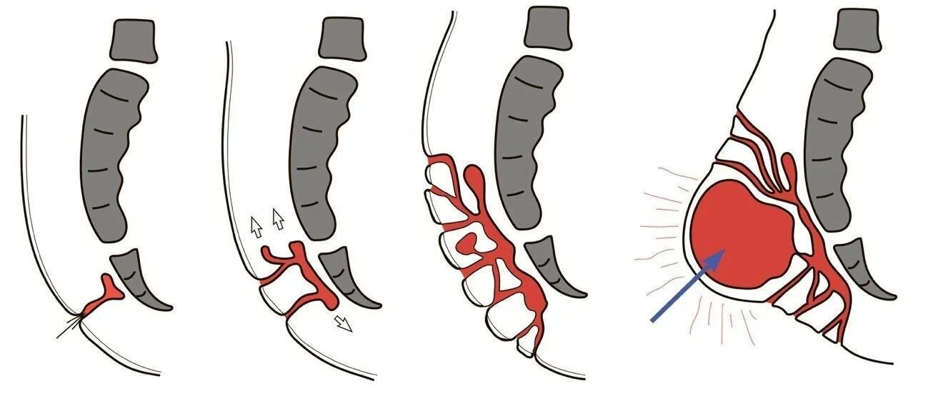 Киста эпителиального копчикового хода. Копчиковая киста ход операции. Эпителиальный копчиковый ход. Эпителиальный ход кисты копчика. Боли внутри заднего прохода