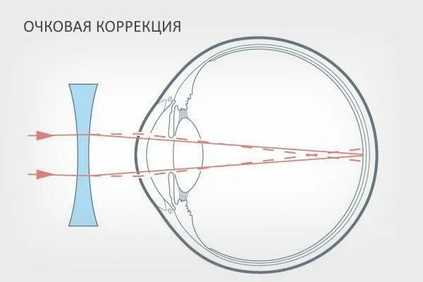Близорукость собирающая