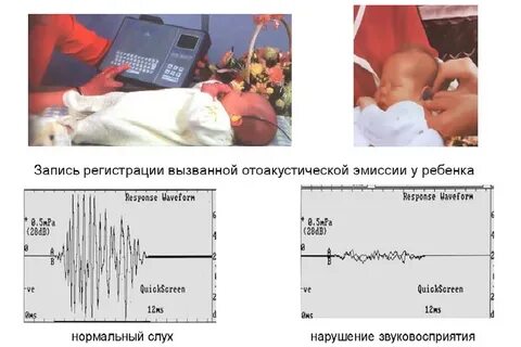 Отоакустическая эмиссия