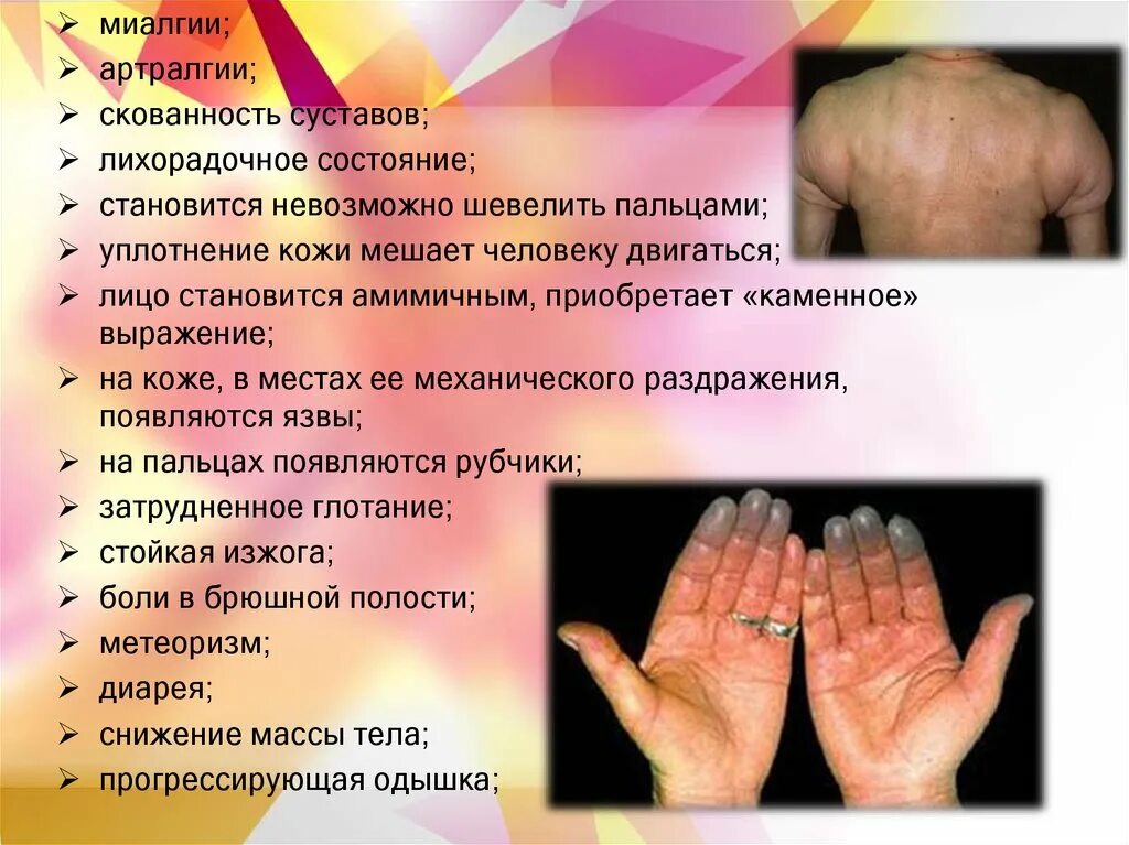 Что такое миалгия и ее симптомы. Аутоиммунные заболевания кожи. кожные проявления аутоиммунных заболеваний. миалгия артралгия невралгия что это.