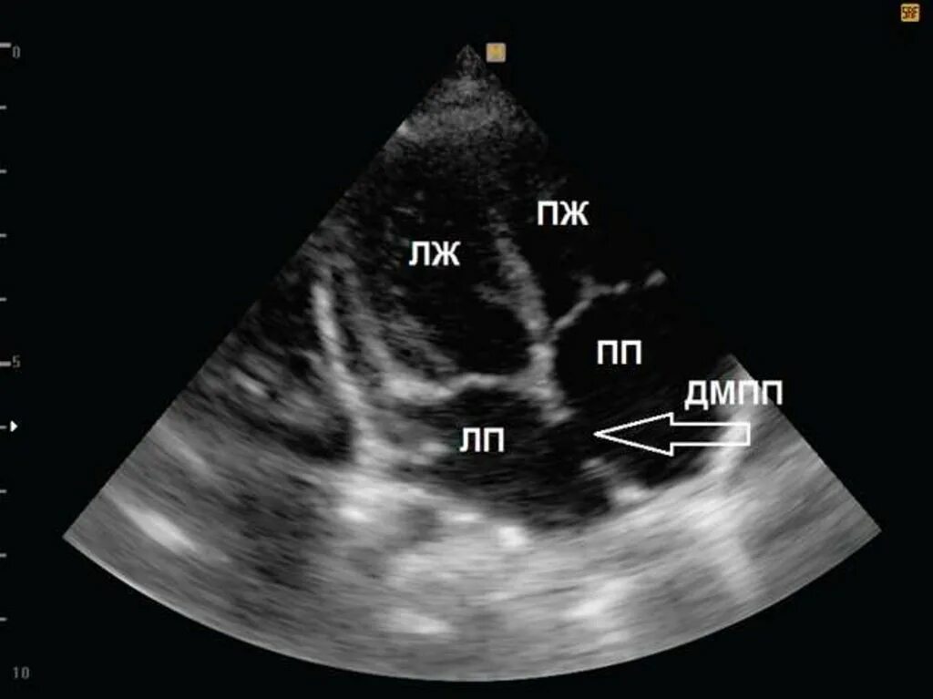 Аневризма перегородки у ребенка. Дефект межжелудочковой перегородки Эхо. Дефект межпредсердной перегородки эхокардиография.
