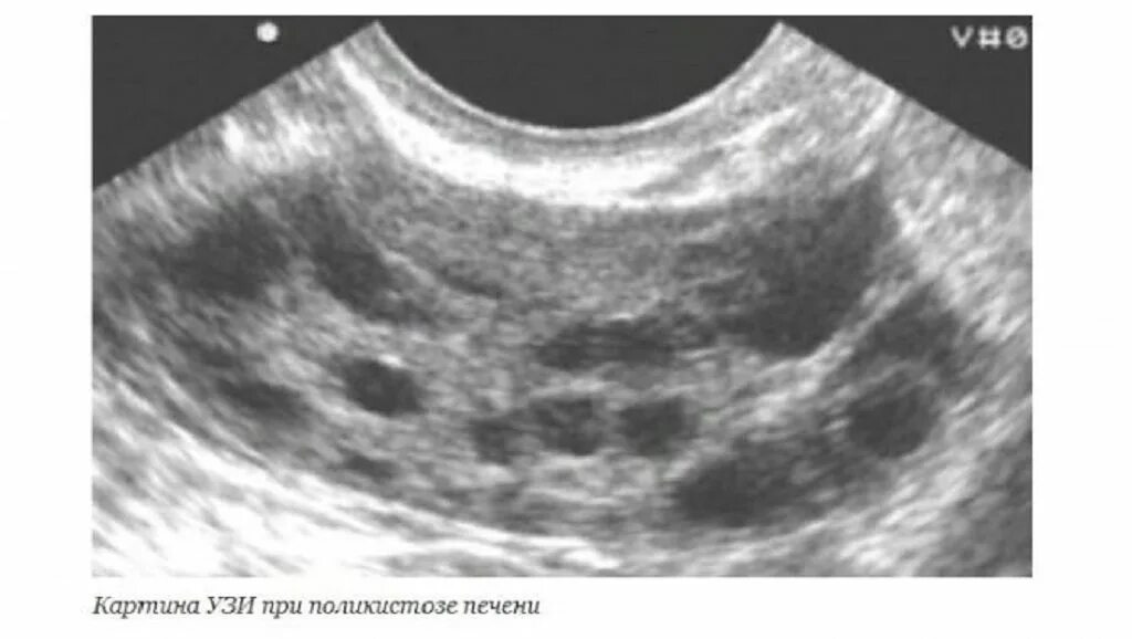 При поликистозе можно забеременеть. Поликистоз яичников на УЗИ. Склерокистоз яичников УЗИ. Поликистозный яичник на УЗИ.