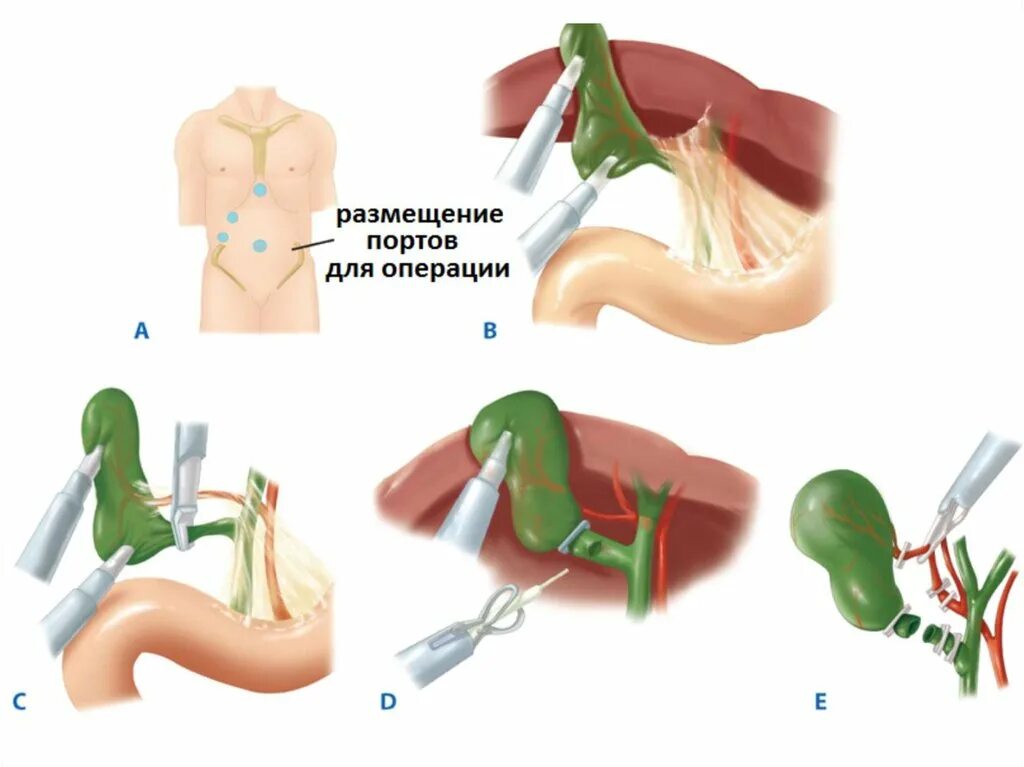 Баня после удаления желчного. Холецистит и лапароскопическая холецистэктомия. Холецистэктомия желчного пузыря лапароскопическая. ЖКБ лапароскопическая холецистэктомия. Лапаротомия холецистэктомия.