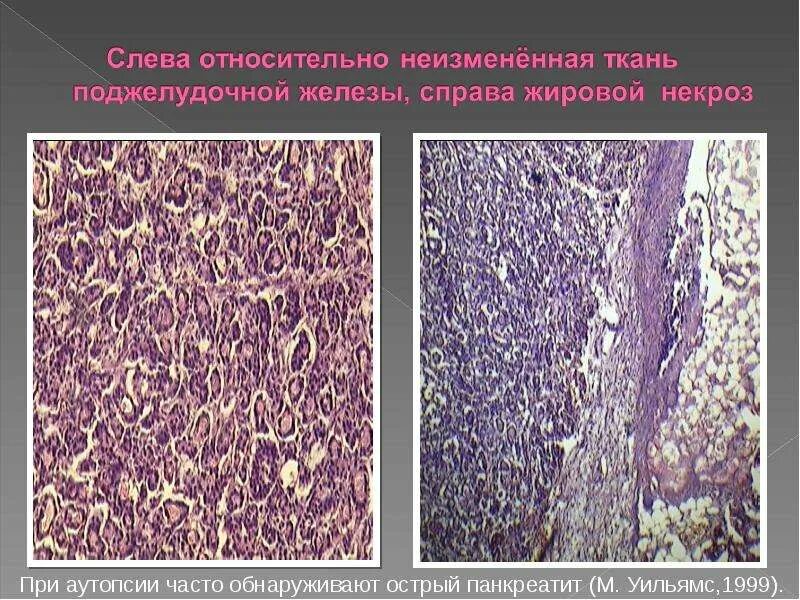 Жировая ткань поджелудочной железы. Липоматозное изменение поджелудочной железы. Гормоны поджелудочной железы анатомия. Стеатоз печени гистология. Вирсунгов проток поджелудочной железы.