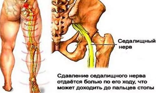 Защемило поясницу отдает в ногу. Неврит седалищного нерва. Седалищный нерв схема. Невропатия седалищного нерва неврология. Седалищный нерв л5 с1.