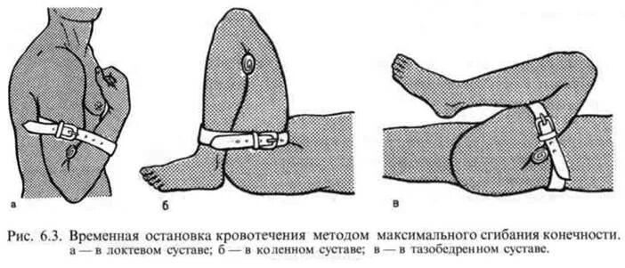 Остановка кровотечения путем сгибания конечности. Остановка кровотечения методом сгибания конечностей. Остановка кровотечения методом максимального сгибания. Максимальное сгибание конечности для остановки кровотечения. Остановка кровотечения максимальным сгибанием конечности в суставе..