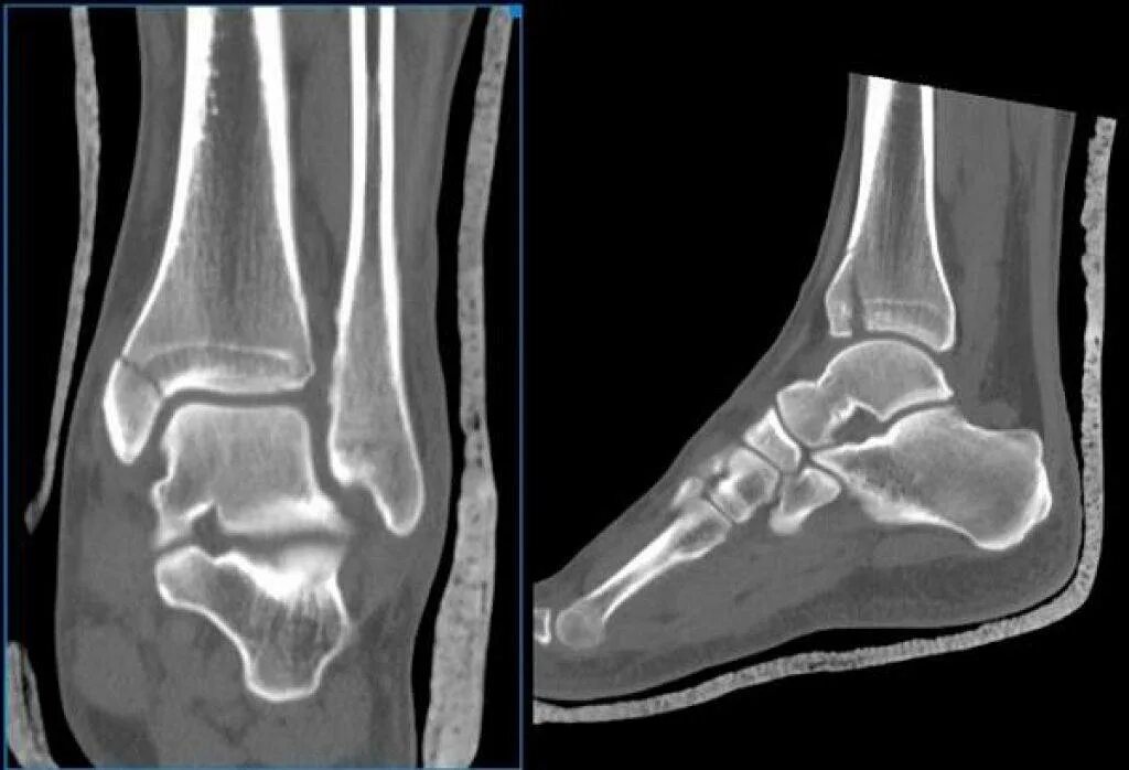 Остеомиелит голеностопного сустава кт. Остеомиелит костей стопы мрт.
