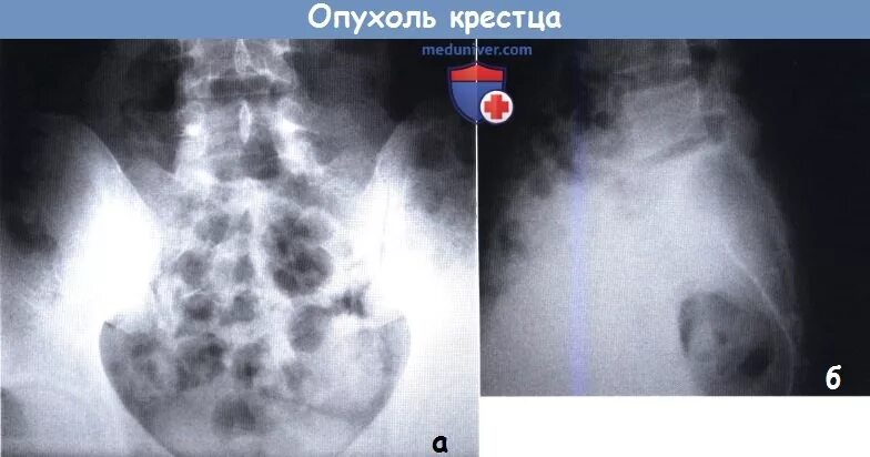 Перелом крестцового отростка. Перелом латеральной массы крестца. Перелом крестца справа. Отек боковой массы крестца. Отек боковой массы крестца.