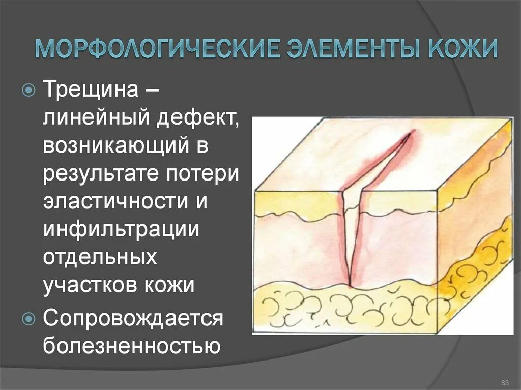 Первичные бесполостные морфологические элементы кожи. Первичные морфологические элементы в дерматологии. Дерматология вторичные морфологические элементы. Монологические элементы кожи. Элементы трещин