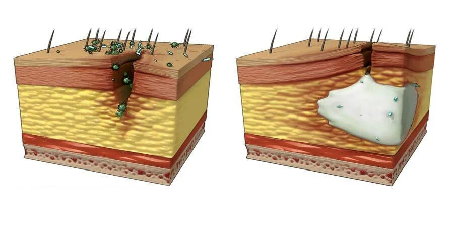 Гнойное воспаление мягких. Абсцесс кожи фурункул и карбункул. Фурункул карбункул флегмона. Фурункул карбункул абсцесс флегмона.