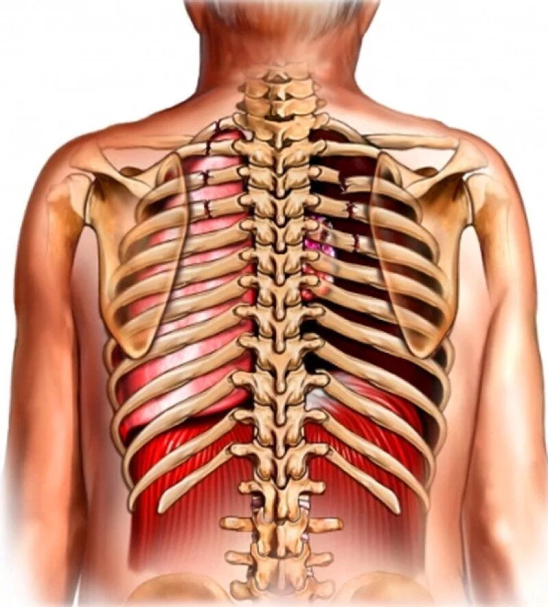 Перелом ребер грудной клетки. Перелом 9 ребра грудной клетки.