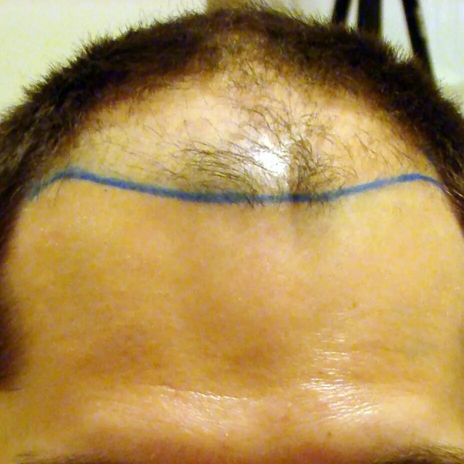 Пересадка волос на брови. Трансплантация волос на брови. Брови пересадка волосяных луковиц. Брови после пересадки волос.