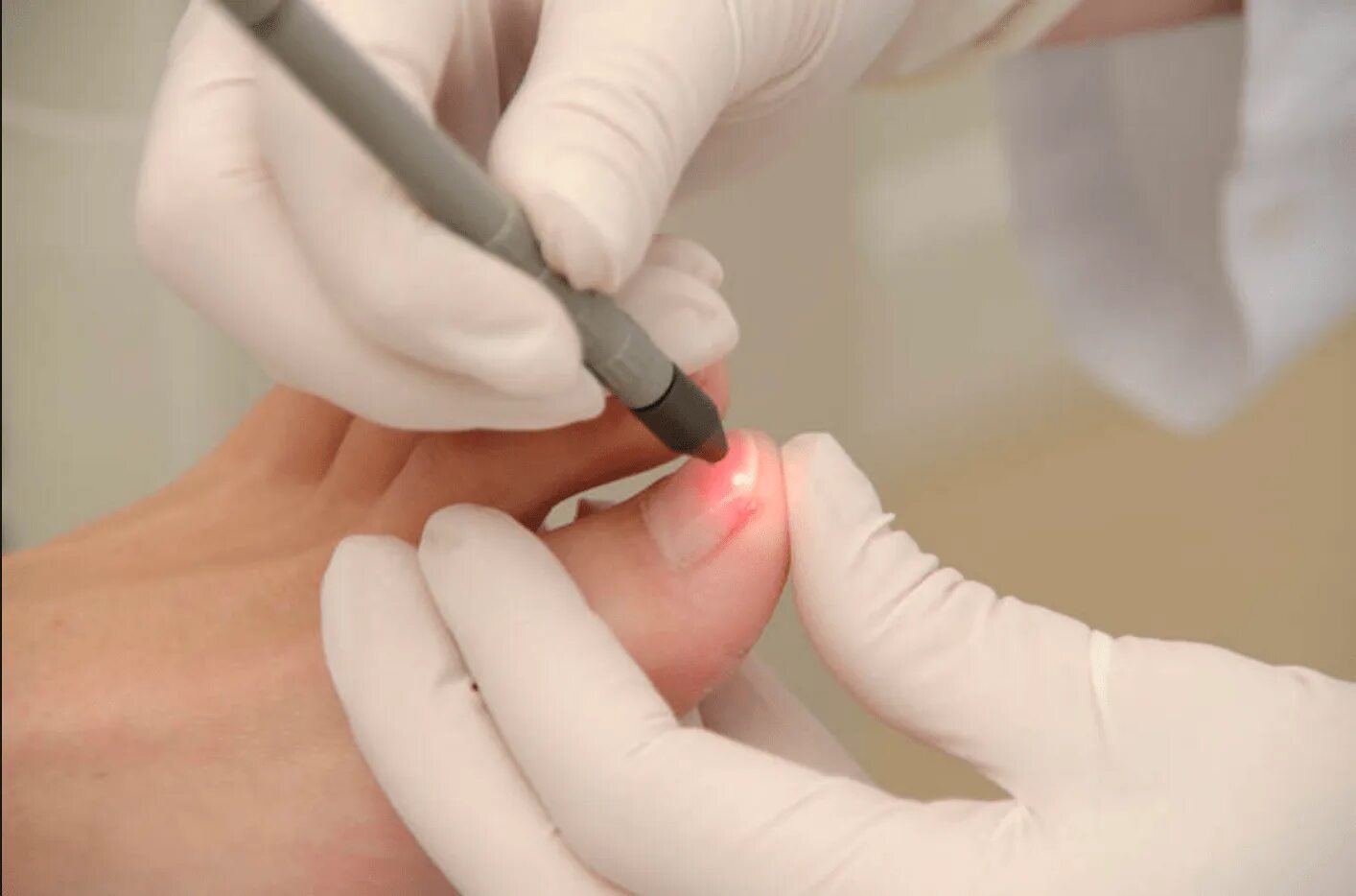 Анестезия для вросшего ногтя. Вросшийся ноготь операция. Вырезание вросшего ногтя лазером. Удалить ноготь на ноге лазером. Резекция вросшего ногтя лазером.