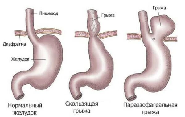 Грыжа пищевода признаки симптомы. Параэзофагеальная грыжа пищеводного отверстия диафрагмы. Грыжи диафрагмального отверстия диафрагмы. Грыжа пищевода 3 степени. Грыжи пищеводного отверстия диафрагмы классификация.