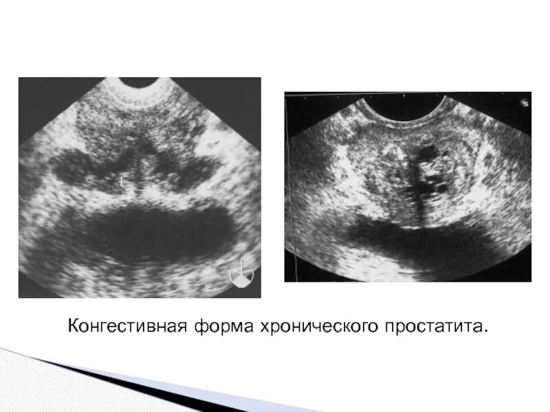 Хронический простатит аденома. Хронический простатит на УЗИ. Форма предстательной железы на УЗИ.