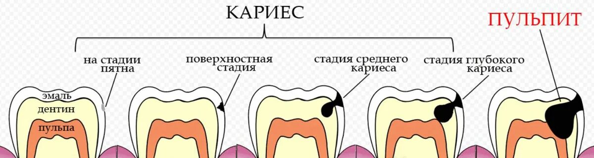 Через 1 стадии. Вторичный кариес схема. Клинические симптомы кариеса зуба.
