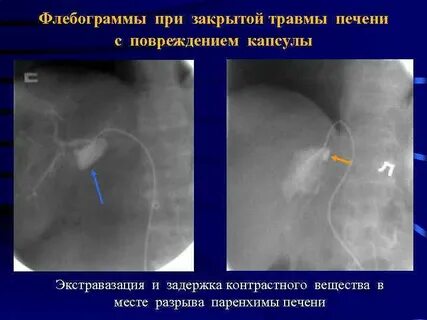 Повреждение печени