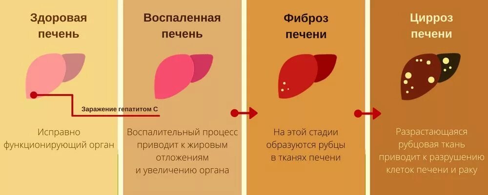 Гепатит с натощак или нет. Стадии развития алкогольного цирроза печени. стадии развития гепатита б. этапы развития цирроза печени f4. гепатит с стадии развития.