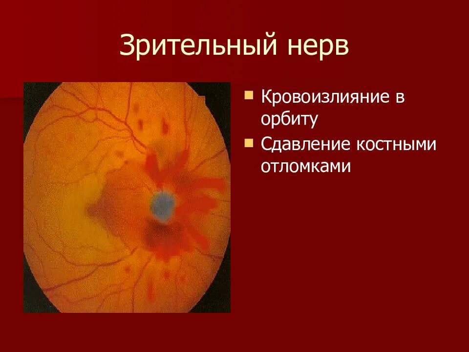 Повреждение зрительного нерва. Повреждение глазного нерва. Поражение хиазмы зрительного нерва. Симптоматика разрыва зрительного нерва. Повреждение зрительного нерва.
