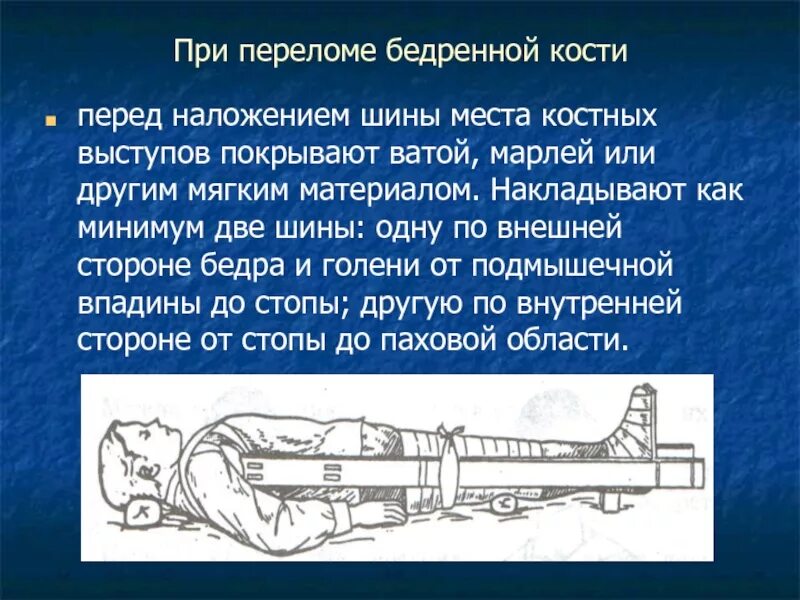 Наложение шины при переломе бедренной кости