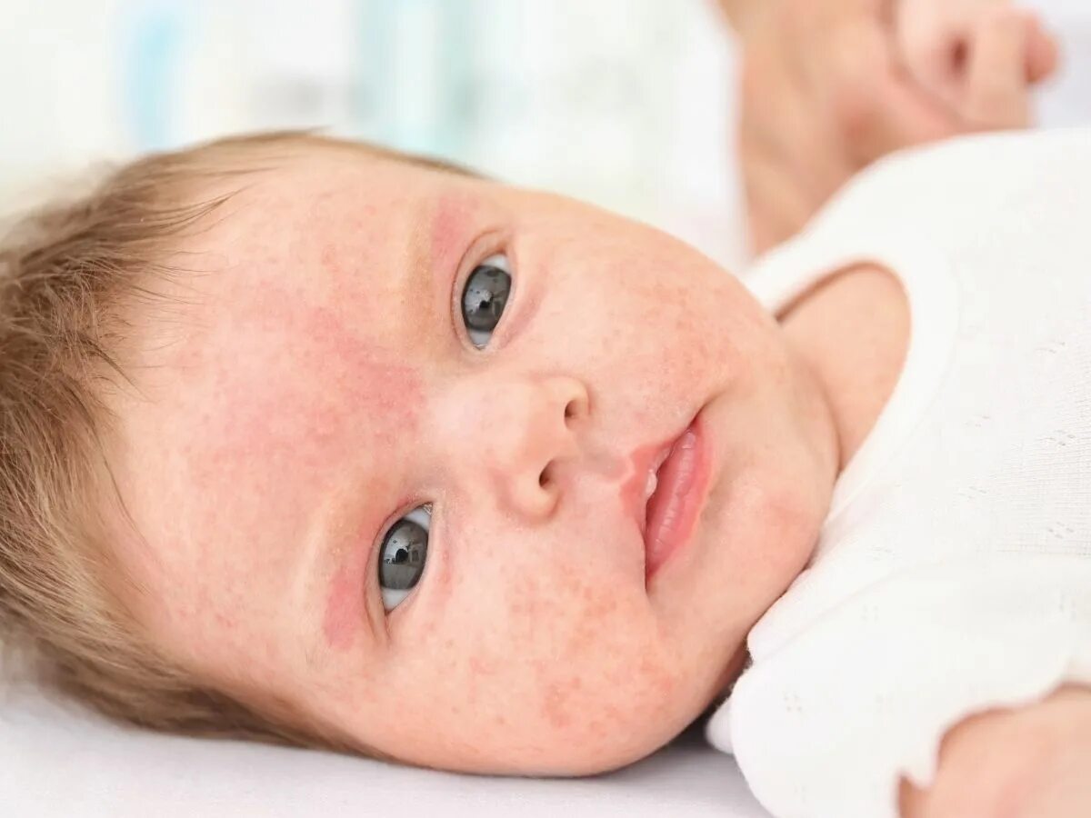 Грудной ребенок. Физиологическая желтушка у новорожденного. Насморк у грудного ребенка. Has babies in. Has babies in.