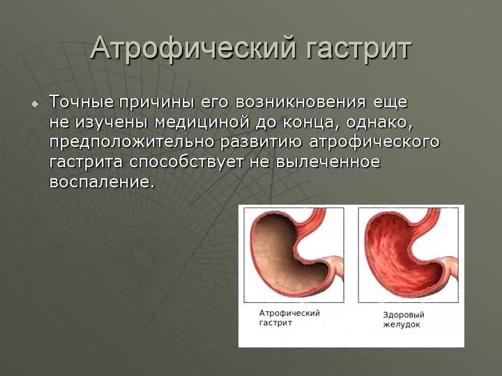 Степени активности хронического гастрита. Факторы атрофического гастрита. Атрофический гастрит предрак. Атрофированный гастрит желудка. Хронический гастрит проявления.