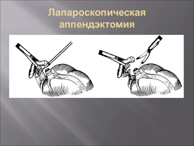 Видеолапароскопическая аппендэктомия. Лапароскопическая аппендэктомия этапы операции. Острый аппендицит ход операции. Антеградная лапароскопическая аппендэктомия.